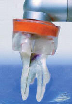 Léčba zubů ozónem, ošetření ozónem, ozónová terapie, ozonoterapie, HealOzone