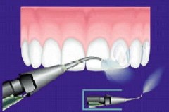 Pískování zubů, profesionální čistění zubů